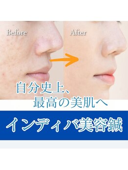 オラ鍼灸院 麹町(OLA鍼灸院)/インディバ美容鍼