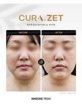 ミロク(369)/韓国発最新脂肪分解注入