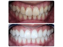 福山市では稀少な医療提携ホワイトニング/福山市ホワイトニング