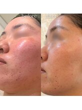 エステティックサロン ナチュラーレ/ニキビ・顔全体の赤み