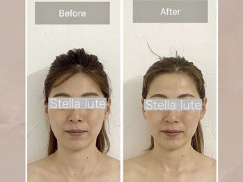 ステラルーテ(Stella lute)/脳洗浄 1回