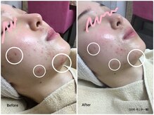 ラウレア(LAULEA)/ハーブピーリングBefore/after