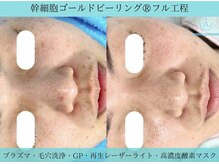 リメイククリニカルビューティー(Remake clinical beauty)/幹細胞ゴールドピーリング