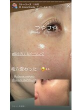 エルール トータルビューティ(Aileure total beauty)/最新ピーリング　ララピール