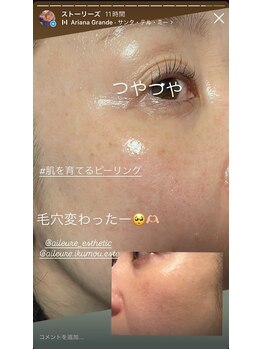 エルール トータルビューティ(Aileure total beauty)/最新ピーリング　ララピール