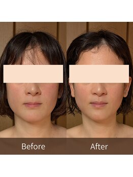 ルマ(Rumah)/エラ張りに効果大の小顔矯正