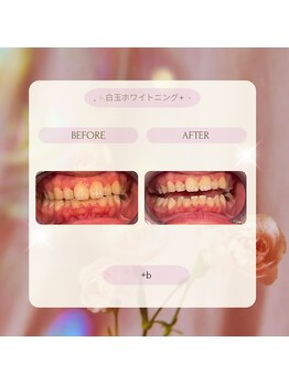 プラスビー 2号店(+b)/ホワイトニングビフォーアフター