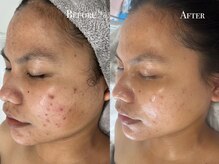 イースト(EAST)/プラズマシャワー2回