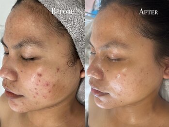 イースト(EAST)/プラズマシャワー2回