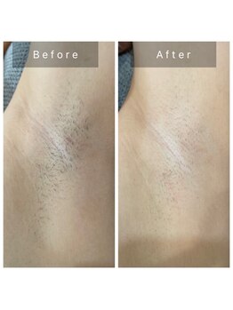 サロン ド パーフェクション(Salon de Perfection)/ワキ脱毛