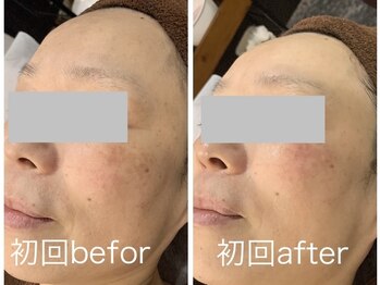 ケイ(Kei)/肌質改善コース☆before/after