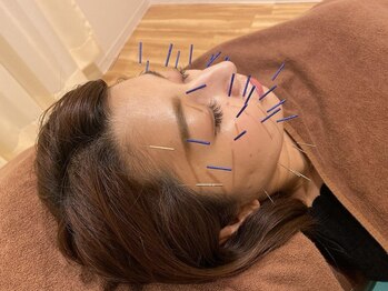 上野毛 よつば整骨院の写真/【効果重視！地域トップレベルの美容鍼☆】様々なお悩みの原因となるお顔の『たるみケアに特化』した施術！