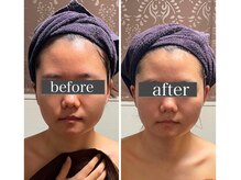 小顔アンドエイジングケア専門店 ビゼ(美sser)/おでこが小さく☆