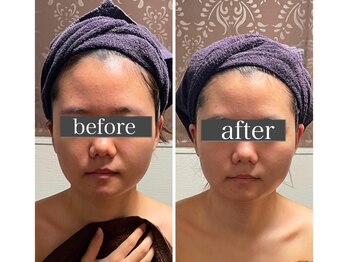 小顔アンドエイジングケア専門店 ビゼ(美sser)/おでこが小さく☆