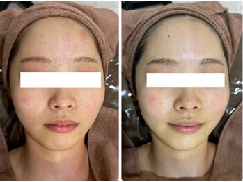 ホワイトアクア 四日市店(WHITE AQUA)/ニキビケア/四日市ハーブ