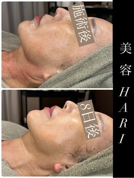 ビーエルティー(blt)/VOSサロンケア White