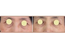 ブリリアント 西宮(Brilliant)/目の下のたるみが改善