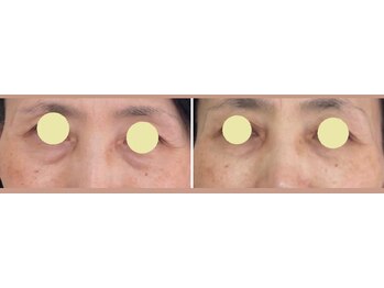 ブリリアント 西宮(Brilliant)/目の下のたるみが改善