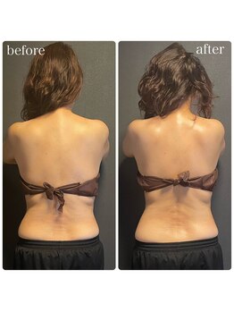 ミミ(MIMI)/【リラク】活性デトックスリンパ