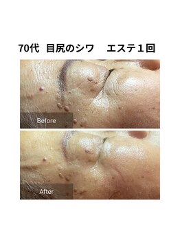 ヒール(heal)/目尻のシワも目立たなく♪