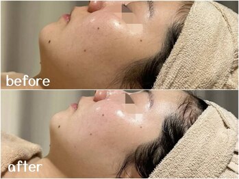 サロン ド ブラン アオヤマ(Salon de BLANC AOYAMA)/クリスティーナハーブピーリング