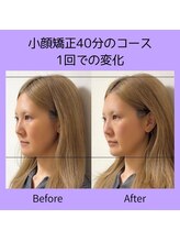 カンビアーレ(cambiare)/小顔矯正ビフォーアフター