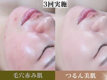 3回でニキビ・赤み・毛穴ケア/つるんとふわふわお肌になる！