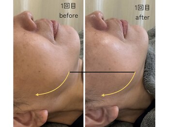 ほねつぎ一休さん 宇品店/小顔フェイシャル