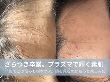 ラシック 加古川店(La chic.)の雰囲気（繰り返す肌荒れに。プラズマシャワーで整える、自信の持てる肌。）