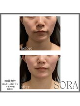 ソラ 天神 大名(SORA)/切らないリフト1回60kj