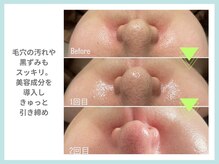 リラクゼーションアンドビューティーボヌール(BONHENR)/JET PEELの効果