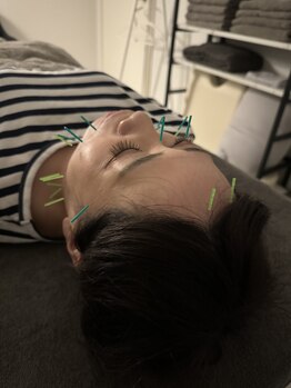 ラフテル鍼灸整骨院/堀江で美容鍼受けれます！