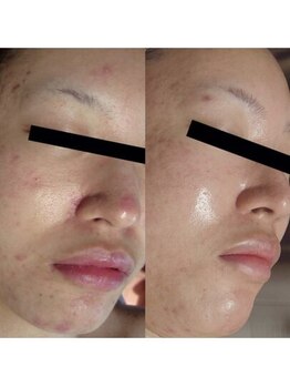 ホワイトアクア 姫路店(WHITE AQUA)/ララピール/姫路/美肌