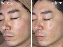 ホワイトアクア 浜松店(WHITE AQUA)/ララピール/ニキビケア