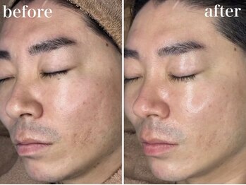 ホワイトアクア 浜松店(WHITE AQUA)/ララピール/ニキビケア