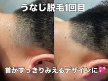 リエル(RIEL)/【うなじ脱毛】