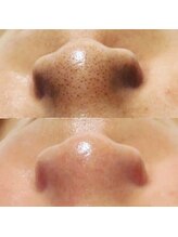 ルーラ(LURA)/ハイドラフェイシャル