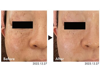 ピオラ(Piora)/ホワイトスノーピール/12回