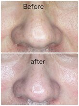 ルミネル 名古屋新栄(Luminelle)/エクソソーム　エラスチン導入