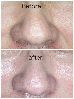 ルミネル 名古屋新栄(Luminelle)/エクソソーム　エラスチン導入