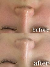 エードット スパ アンド ハーブ(a.spa & herb)/ハーブピーリング