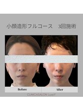 リュクシー(LuxeY)/30代小顔造形フルコース 3回施術