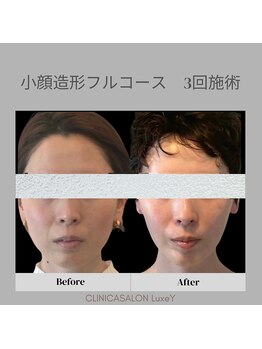 リュクシー(LuxeY)/30代小顔造形フルコース 3回施術