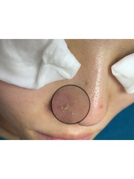 毛穴ケアをしたい