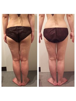 サロン リーナ 北千住店(Salon Lena)/西洋式深層強力リンパ+体質整鍼