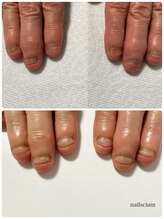 ネイルズシアム/深爪矯正