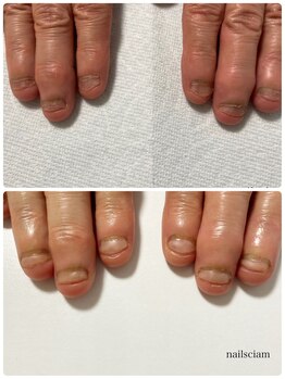 ネイルズシアム/深爪矯正