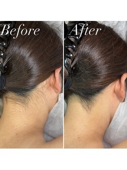 インベスト(INVEST)/うなじ脱毛