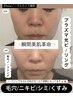 【瞬間美肌革命】美白ノーファンデを叶える♪最新!プラズマ×光フェイシャル