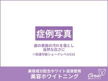 クレア(Crea)/【ホワイトニング症例写真】